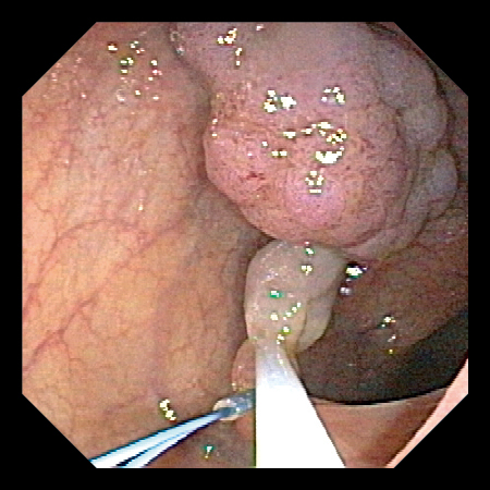 Esg 150 内視鏡画像１ 1