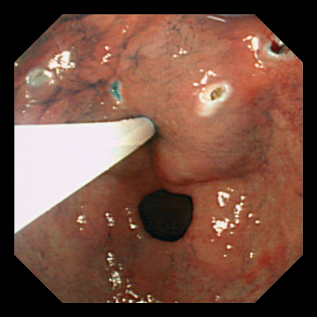 Esg 150 内視鏡画像２ 1