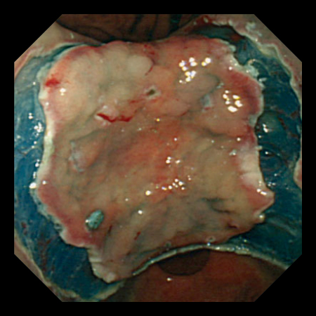 Esg 150 内視鏡画像３ 0