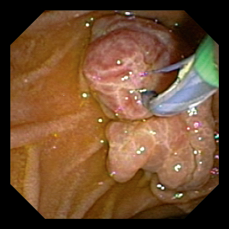 Esg 150 内視鏡画像４ 0