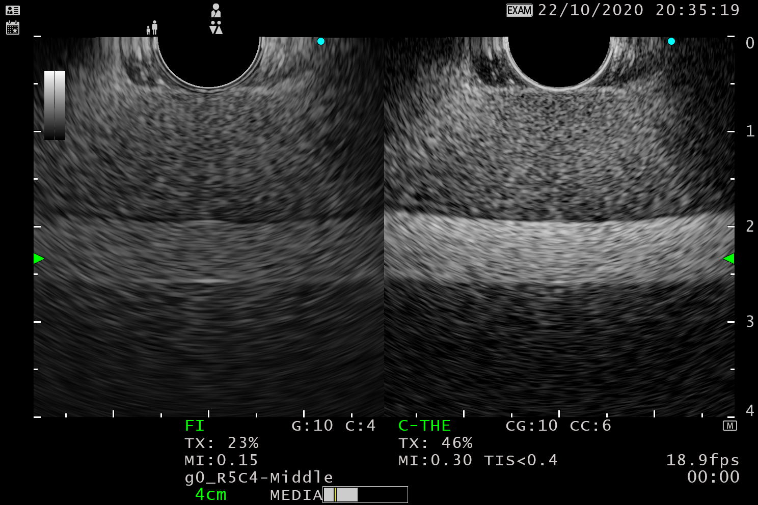 Gf Uct180 C The Sonazoid