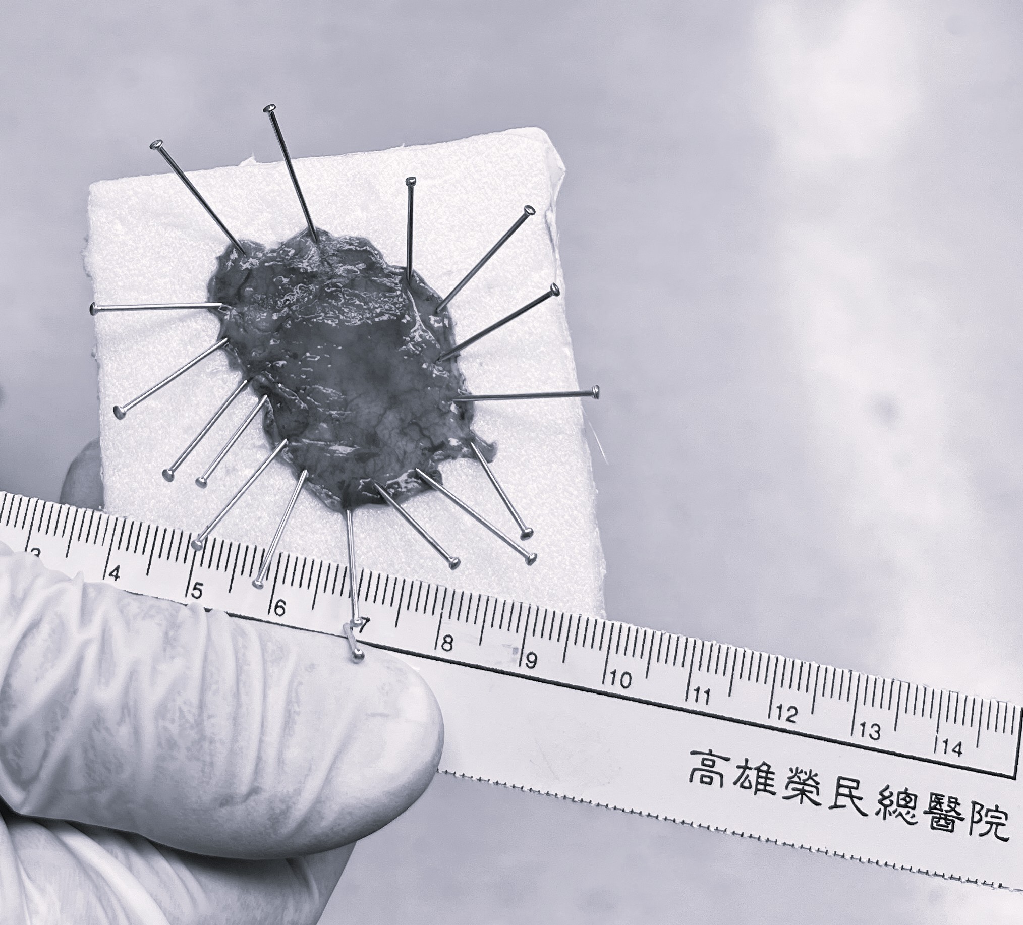 Precancerous Lesions