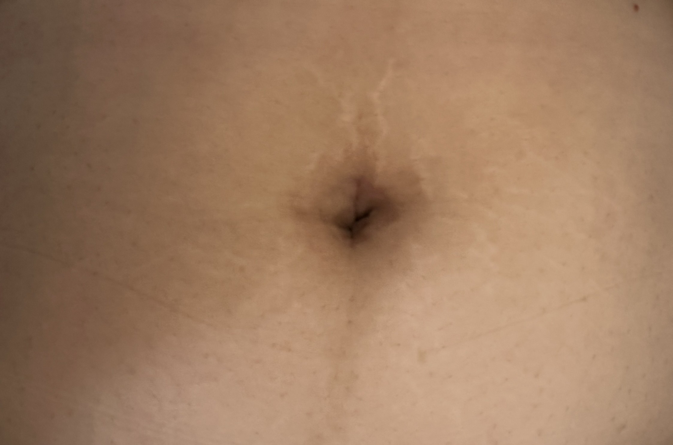 After Surgery