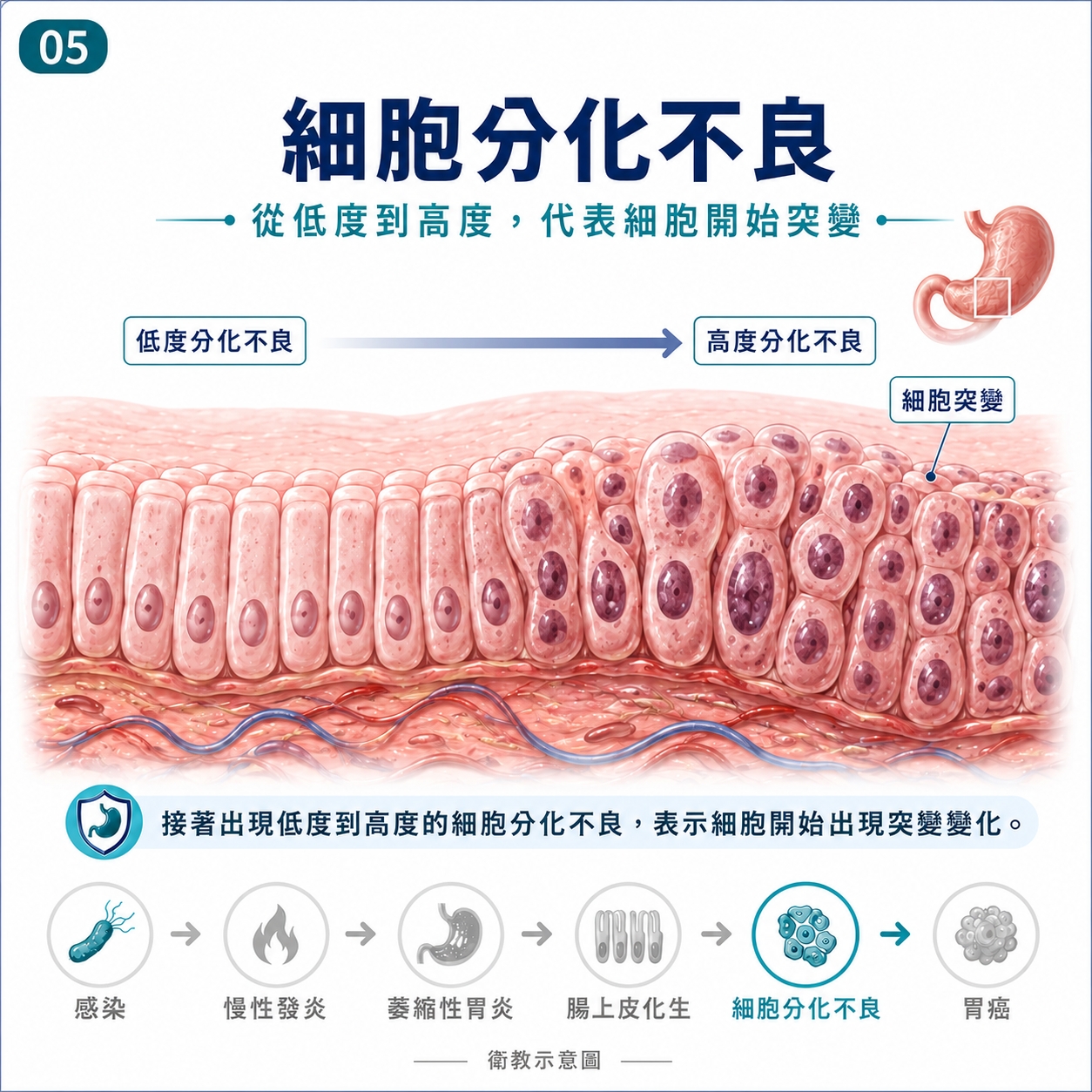 細胞分化不良