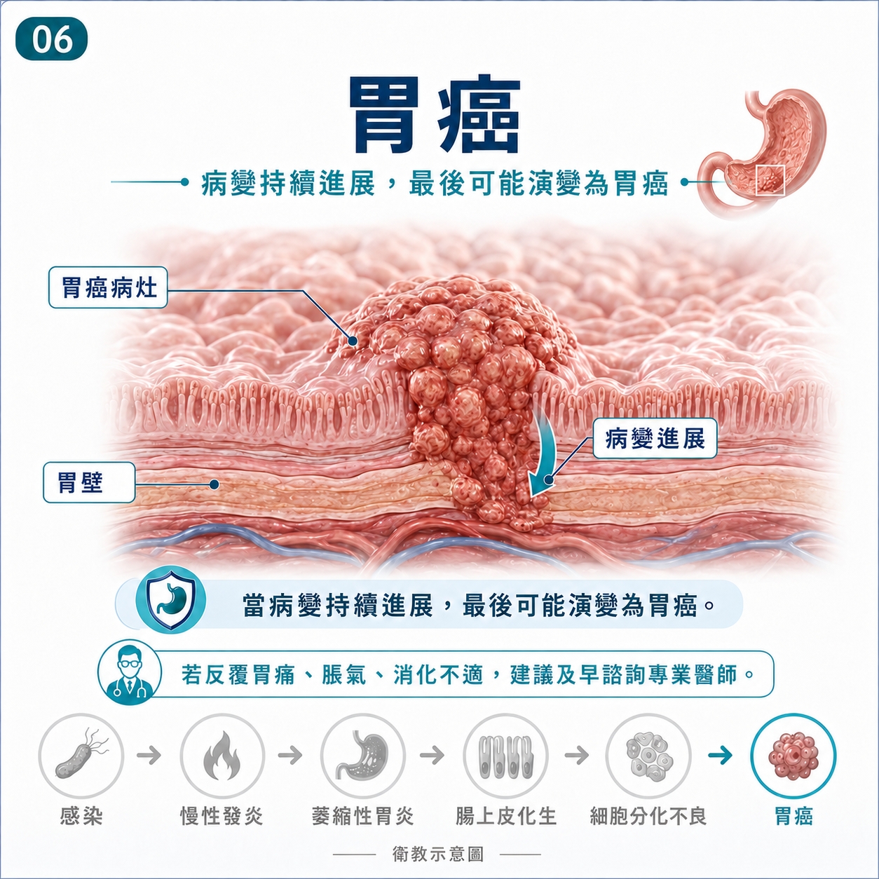 胃癌