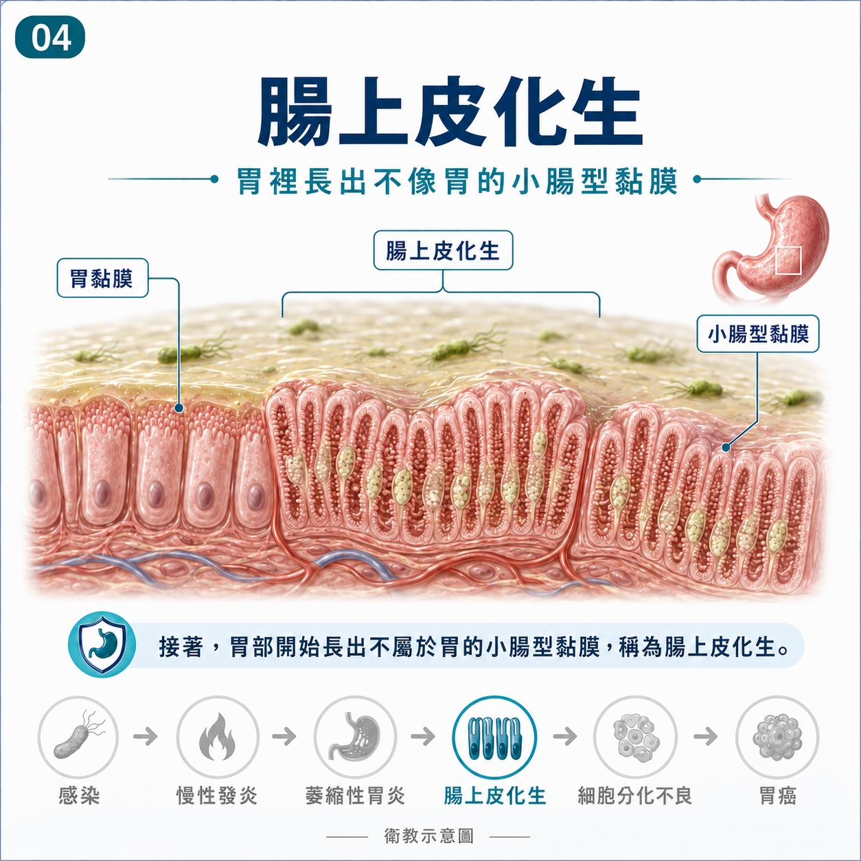 腸上皮化生
