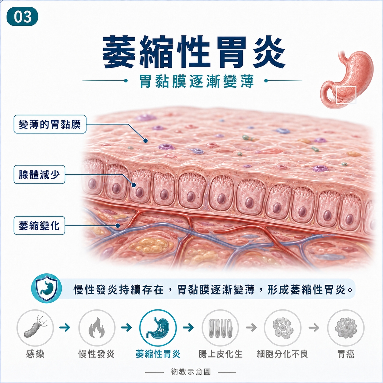 萎縮性胃炎