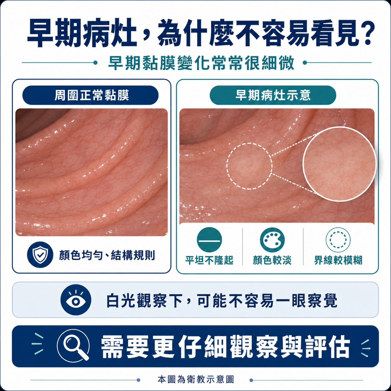 早期病灶