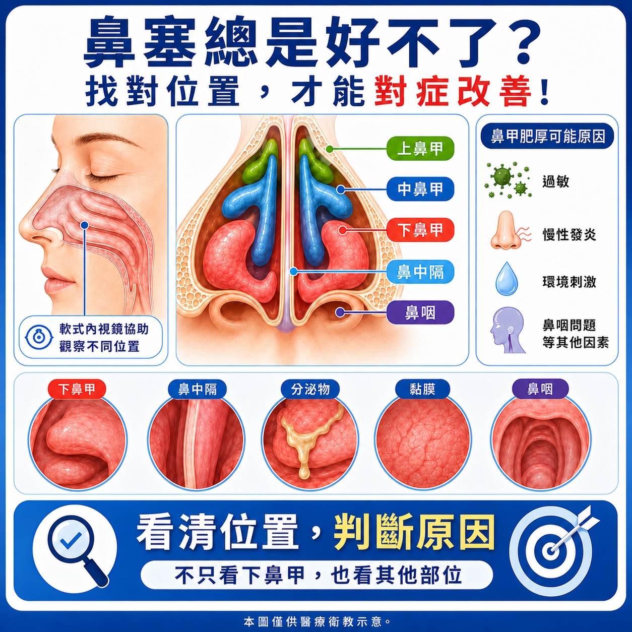 影片3 小圖 New 4. 軟式內視鏡,幫助看清鼻塞原因