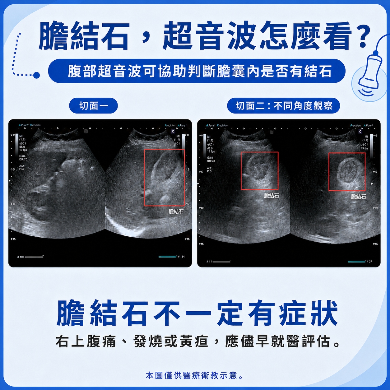 小圖 圖6.腹部超音波 膽結石